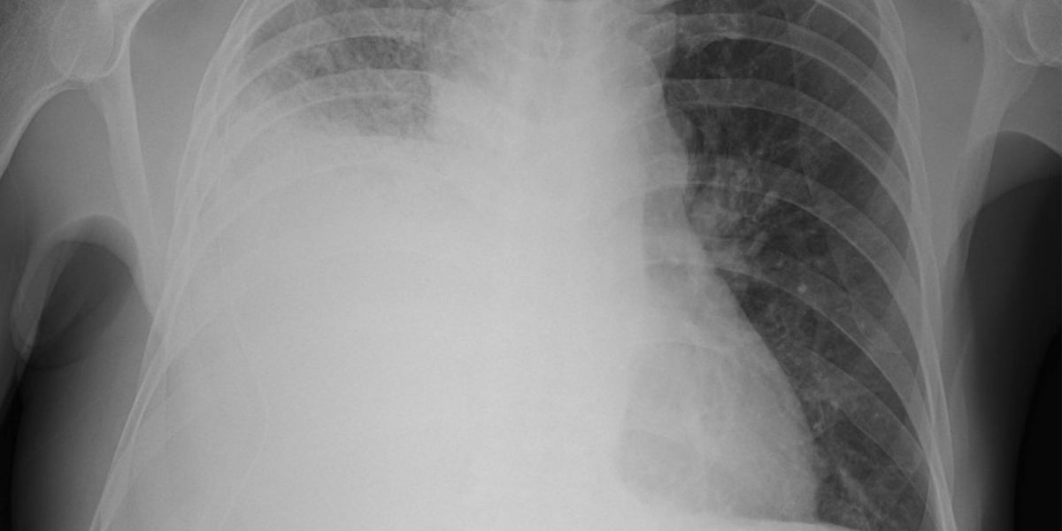 Pulmonologist reviewing chest imaging for pleural effusion treatment in Morristown TN